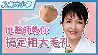 【願麗醫美】廖苑利醫師教你如何正確消滅黑頭粉刺 ！