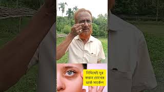 নিমিষেই দূর করুন ডার্ক সার্কেল।  #eye #dark #circles #medicine