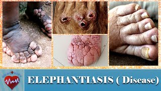 WHAT IS ELEPHANTIASIS DISEASE | CAUSES, SYMPTOMS AND TREATMENT OF ELEPHANTIASIS | BIG FOOT DISEASE