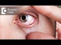 What causes visible red fine lines in eyes? - Dr. Elankumaran P What causes visible red fine lines in eyes? - Dr. Elankumaran P