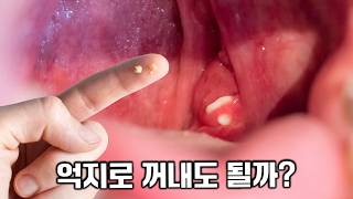 입에서 나오는 냄새나는 노란 알갱이의 정체