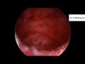 diagnosis of smf during hysteroscopic removal of rpoc in a case of boh