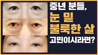 [JPN/CHI sub] 중년 분들, 눈 밑 불룩한 살 고민이시라면? 전후사진 보면서 나에게 딱 맞는 수술법 알아보자!