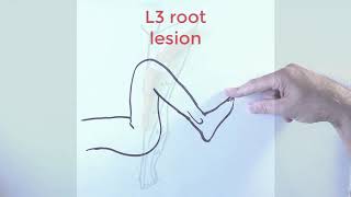 L3 nerve root lesion