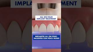 REPLACING lost TEETH with 4 IMPLANTS is possible