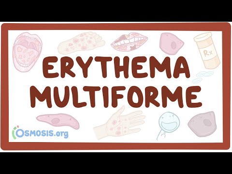 What causes erythema in the stomach?