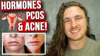 How To Get Rid of Hormonal Acne (SCIENTIFICALLY) | PCOS