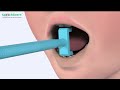 Tongue Elevation with SpeechGears™ TT-UD™ Oral Motor Tool