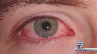 How To Prevent Pink Eye