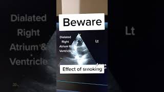 Dialated RA RV due to smoking | Cor pulmonale | Quick Health Tips by Dr.Paramjeet