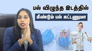 Importance of dental bonding treatment | பல் விழுந்த இடத்தில் மீண்டும் பல் கட்டணுமா