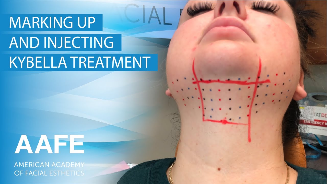 Marking Up And Injecting Kybella - YouTube