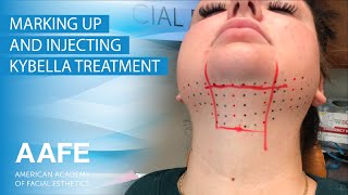 Marking Up and Injecting Kybella