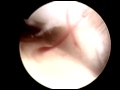 Ankle Arthroscopy