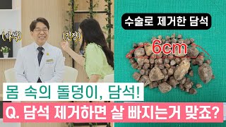 담석제거하면 살이 빠질까요?｜담석증편 [G1 홈닥터 21회 미방영분]