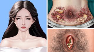 ASMR Remove Big Acne & Worm Infected Belly | Deep Cleaning Animation