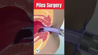 Piles Surgery 3d animation ll #youtubeshorts # viral shorts