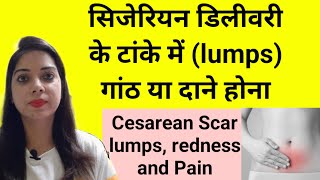 सिजेरियन डिलीवरी के टांके में गांठ और सूजन | Cesarean ke tanke me dard | Cesarean scar thickness