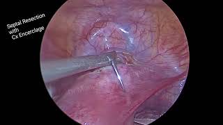 Laparoscopy Cervical interval cerclage /#incompetent cervix/#uterus/#Septate uterus