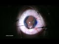 artificialiris management of congenital aniridia with cataract and astigmatism