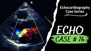 ECHO CASE 76 | Echocardiography spot diagnosis Series | Echocardiogram Interpretation