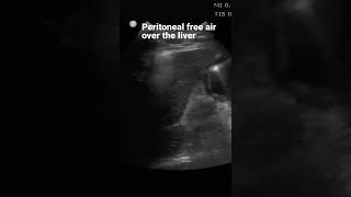 Peritoneal Free Air Over the Liver.  #pocus #ultrasound