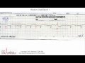 ECG Interpretation Tutorial - ChalkTalk 11 - Basic Level