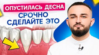 Почему опускается десна? 3 способа остановить рецессию десны