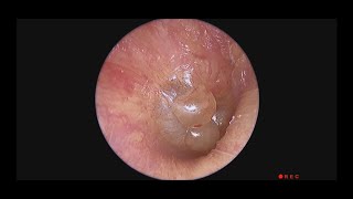 Acute Bullous Myringitis Complicating Infected Nasopharyngeal Lymphoid Tissue