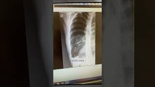 She Finally Quit Vaping After Her Lung Collapsed