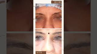 Amazing Results 🤩 for Eyelid dropping correction #shorts #eyes