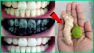 ২ মিনিটে দাঁতের যে কোন হলুদ,কালো দাগ সহজে দুর করতে চাইলে দেখুন | Teeth whitening best home remedy