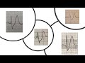 ecg tip 3. the st segment is depressed is that bad