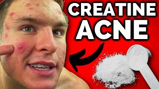 Does Creatine Cause Acne? FINALLY,  SOME ANSWERS!