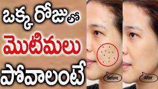 ఒక్కరోజు లో మొటిమలు పోవాలంటే | How to Remove Pimples in Face with in One Day | Health Tips