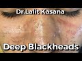 Deep BLACKHEAD Removal by Dr.Lalit Kasana / New Video