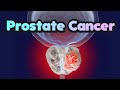 Prostate Cancer - CRASH! Medical Review Series