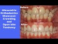 Alexandria Orthodontics Showcase: Crowding⁠ and Open bite