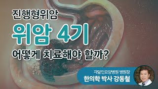 진행형위암, 위암 4기 어떻게 치료해야 할까?