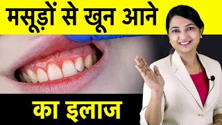 मसूड़ों से खून आने का इलाज | Bleeding Gums? Causes and Treatment of Bleeding Gums at Home |