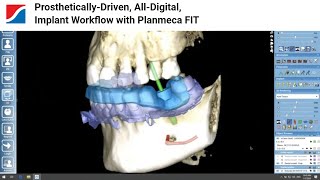 Prosthetically-Driven, All-Digital, Implant Workflow with Planmeca FIT