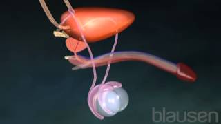 Vasectomy Animation