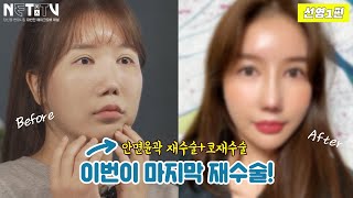 ✔이번이 정말 마지막 재수술!! 안면윤곽재수술+코재수술(자가늑연골) 후기 공개 [넷미인TV]