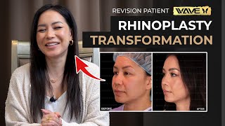 Fixing a Botched Rhinoplasty! Great Before & After Results after we fixed her asian nose!
