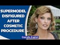 Supermodel 'brutally disfigured' after fat freezing procedure, claims $50 mn | Oneindia News