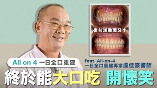 【All-on-4一日全口重建】終於能大口吃開懷笑！一口好牙，再次重回年輕∣台南悅康牙醫｜楓鄰牙醫∣盧佳豪醫師