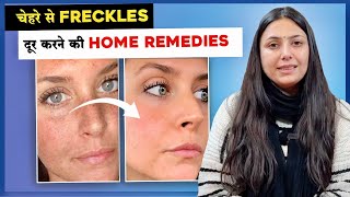 चेहरे से Freckles दूर करने की Home Remedies | Pigmentation Jhaiya Remedy | Upasana Ki Duniya