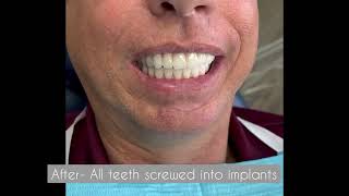 Complete Smile Makeover: The Benefits of Full Mouth Dental Implant Reconstruction