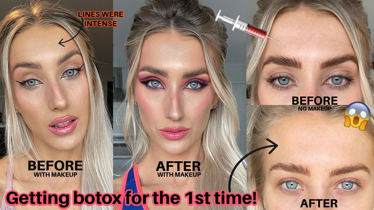 Getting Botox Brow Lift Before After Vlog Vrogue Co Getting Botox Brow Lift Before After Vlog Vrogue Co