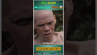 നിറം മാറുന്ന അപൂർവ രോഗം | A Black Man Who Turned to White #shorts #youtubeshorts #facts